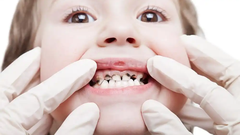 Наліт Прістлі у дітей: стоматологи “Фенікс-Дент” пояснюють як діяти