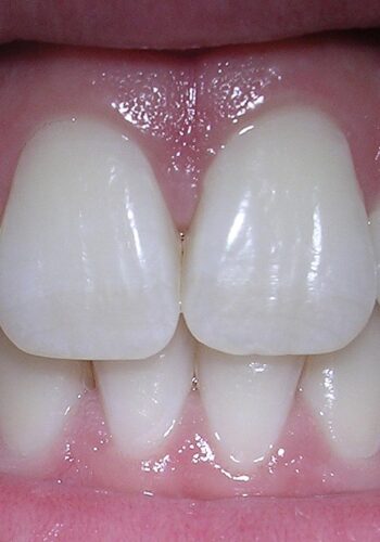 Мезіальний прикус: як розпізнати і чому не варто відкладати лікування