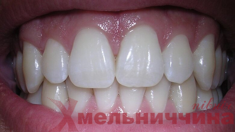 Мезіальний прикус: як розпізнати і чому не варто відкладати лікування