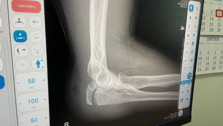 Коли зима б’є з-під ніг: у Нетішині фіксують сплеск травм через ожеледицю